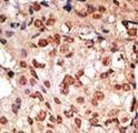 SIGLEC7 / CD328 Antibody - Formalin-fixed and paraffin-embedded human cancer tissue reacted with the primary antibody, which was peroxidase-conjugated to the secondary antibody, followed by DAB staining. This data demonstrates the use of this antibody for immunohistochemistry; clinical relevance has not been evaluated. BC = breast carcinoma; HC = hepatocarcinoma.