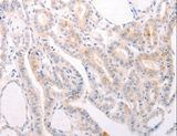 SIPR3 / EDG3 / S1P3 Antibody - Immunohistochemistry of paraffin-embedded Human thyroid cancer using S1PR3 Polyclonal Antibody at dilution of 1:30.