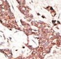 SIRT3 / Sirtuin 3 Antibody - Formalin-fixed and paraffin-embedded human cancer tissue reacted with the primary antibody, which was peroxidase-conjugated to the secondary antibody, followed by AEC staining. This data demonstrates the use of this antibody for immunohistochemistry; clinical relevance has not been evaluated. BC = breast carcinoma; HC = hepatocarcinoma.