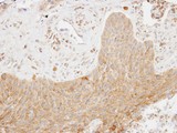 SKAP2 / SCAP2 Antibody - IHC of paraffin-embedded lung ca using SCAP2 antibody at 1:100 dilution.