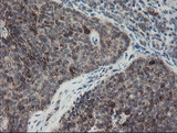 SKIL / SNO / SnoN Antibody - IHC of paraffin-embedded Carcinoma of Human pancreas tissue using anti-SKIL mouse monoclonal antibody.