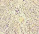 SKIV2L / SKI2 Antibody - Immunohistochemistry of paraffin-embedded human ovarian cancer at dilution of 1:100