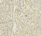 SKIV2L / SKI2 Antibody - Immunohistochemistry of paraffin-embedded human ovarian cancer at dilution of 1:100