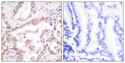 SKP2 Antibody - Immunohistochemistry analysis of paraffin-embedded human lung carcinoma tissue, using SKP2/p45 Antibody. The picture on the right is blocked with the synthesized peptide.