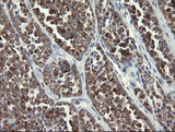 SLA2 / SLAP2 Antibody - IHC of paraffin-embedded Carcinoma of Human thyroid tissue using anti-SLA2 mouse monoclonal antibody.