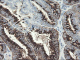 SLA2 / SLAP2 Antibody - IHC of paraffin-embedded Adenocarcinoma of Human endometrium tissue using anti-SLA2 mouse monoclonal antibody.