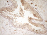 SLAMF7 / CRACC Antibody - IHC of paraffin-embedded Adenocarcinoma of Human endometrium tissue using anti-SLAMF7 mouse monoclonal antibody. (Heat-induced epitope retrieval by 1 mM EDTA in 10mM Tris, pH8.5, 120°C for 3min).