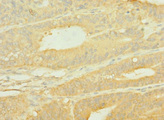 SLC10A2 / ASBT Antibody - Immunohistochemistry of paraffin-embedded human endometrial cancer using SLC10A2 Antibody at dilution of 1:100