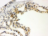 SLC12A1 / NKCC2 Antibody - SLC12A1 antibody IHC-paraffin: Human Kidney Cancer Tissue.