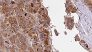 SLC16A1 / MCT1 Antibody - 1:100 staining human liver carcinoma tissues by IHC-P. The sample was formaldehyde fixed and a heat mediated antigen retrieval step in citrate buffer was performed. The sample was then blocked and incubated with the antibody for 1.5 hours at 22°C. An HRP conjugated goat anti-rabbit antibody was used as the secondary.