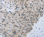 SLC16A4 Antibody - Immunohistochemistry of paraffin-embedded human esophagus cancer tissue.