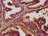 SLC19A2 / TC1 Antibody - Immunohistochemistry image at a dilution of 1:300 and staining in paraffin-embedded human prostate tissue performed on a Leica BondTM system. After dewaxing and hydration, antigen retrieval was mediated by high pressure in a citrate buffer (pH 6.0) . Section was blocked with 10% normal goat serum 30min at RT. Then primary antibody (1% BSA) was incubated at 4 °C overnight. The primary is detected by a biotinylated secondary antibody and visualized using an HRP conjugated SP system.