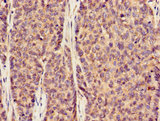 SLC20A1 Antibody - Immunohistochemistry image of paraffin-embedded human ovarian cancer at a dilution of 1:100