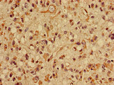 SLC22A2 Antibody - Immunohistochemistry image of paraffin-embedded human glioma cancer at a dilution of 1:100