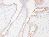 SLC22A6 / OAT1 Antibody - IHC analysis of SLC22A6 using anti-SLC22A6 antibody. SLC22A6 was detected in paraffin-embedded section of human mammary cancer tissues. Heat mediated antigen retrieval was performed in citrate buffer (pH6, epitope retrieval solution) for 20 mins. The tissue section was blocked with 10% goat serum. The tissue section was then incubated with 1µg/ml rabbit anti-SLC22A6 antibody overnight at 4°C. Biotinylated goat anti-rabbit IgG was used as secondary antibody and incubated for 30 minutes at 37°C. The tissue section was developed using Strepavidin-Biotin-Complex (SABC) with DAB as the chromogen.