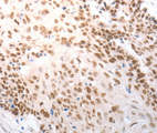 SLC22A8 / OAT3 Antibody - Immunohistochemistry of paraffin-embedded human breast cancer tissue using SLC22A8 antibody.