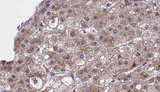 SLC22A8 / OAT3 Antibody - 1:100 staining human liver carcinoma tissues by IHC-P. The sample was formaldehyde fixed and a heat mediated antigen retrieval step in citrate buffer was performed. The sample was then blocked and incubated with the antibody for 1.5 hours at 22°C. An HRP conjugated goat anti-rabbit antibody was used as the secondary.
