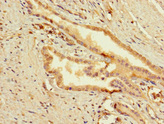 SLC25A10 / DIC Antibody - Immunohistochemistry of paraffin-embedded human prostata cancer at dilution 1:100