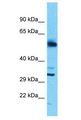 SLC25A30 Antibody - SLC25A30 antibody Western Blot of Uterus Tumor. Antibody dilution: 1 ug/ml.  This image was taken for the unconjugated form of this product. Other forms have not been tested.