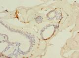 SLC25A4 / ANT Antibody - Immunohistochemistry of paraffin-embedded human breast cancer using antibody at dilution of 1:100.