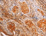 SLC25A4 / ANT Antibody - Immunohistochemistry of paraffin-embedded Human cervical cancer using SLC25A4 Polyclonal Antibody at dilution of 1:40.