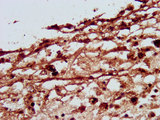 SLC26A4 / Pendrin Antibody - Immunohistochemistry image at a dilution of 1:500 and staining in paraffin-embedded human melanoma cancer performed on a Leica BondTM system. After dewaxing and hydration, antigen retrieval was mediated by high pressure in a citrate buffer (pH 6.0) . Section was blocked with 10% normal goat serum 30min at RT. Then primary antibody (1% BSA) was incubated at 4 °C overnight. The primary is detected by a biotinylated secondary antibody and visualized using an HRP conjugated SP system.