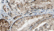 SLC34A2 / NaPi-2b Antibody - 1:100 staining human prostate tissue by IHC-P. The sample was formaldehyde fixed and a heat mediated antigen retrieval step in citrate buffer was performed. The sample was then blocked and incubated with the antibody for 1.5 hours at 22°C. An HRP conjugated goat anti-rabbit antibody was used as the secondary.