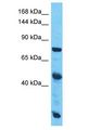 SLC38A10 Antibody - SLC38A10 antibody Western Blot of Esophagus Tumor. Antibody dilution: 1 ug/ml.  This image was taken for the unconjugated form of this product. Other forms have not been tested.