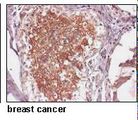 SLC38A2 / SNAT2 Antibody - Human breast carcinoma, FFPE