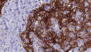 SLC4A9 / AE4 Antibody - 1:100 staining human Head and neck carcinoma tissue by IHC-P. The sample was formaldehyde fixed and a heat mediated antigen retrieval step in citrate buffer was performed. The sample was then blocked and incubated with the antibody for 1.5 hours at 22°C. An HRP conjugated goat anti-rabbit antibody was used as the secondary.