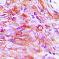 SLC5A3  Antibody - Immunohistochemical analysis of SMIT1 staining in human breast cancer formalin fixed paraffin embedded tissue section. The section was pre-treated using heat mediated antigen retrieval with sodium citrate buffer (pH 6.0). The section was then incubated with the antibody at room temperature and detected using an HRP-conjugated compact polymer system. DAB was used as the chromogen. The section was then counterstained with hematoxylin and mounted with DPX.