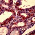 SLC5A5 / NIS Antibody - Formalin-fixed, paraffin-embedded human thyroid gland stained with peroxidase-conjugate and AEC chromogen. Note cytoplasmic staining of follicular epithelium.  This image was taken for the unmodified form of this product. Other forms have not been tested.