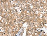 SLC6A7 Antibody - Immunohistochemistry of paraffin-embedded Human breast cancer using SLC6A7 Polyclonal Antibody at dilution of 1:30.