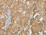 SLC9A3R2 / SIP1 Antibody - Immunohistochemistry of paraffin-embedded Human breast cancer using SLC9A3R2 Polyclonal Antibody at dilution of 1:30.