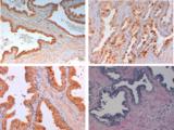 SLIT2 Antibody - Immunohistochemistry of Rabbit anti SLIT-2 Antibody in human breast carcinoma. Tissue: Human prostate. Fixation: FFPE buffered formalin 10% conc. Ag Retrieval: Heat, Citrate pH 6.2. Pressure Cooker, EDTA pH 9.5 Pressure Cooker. Primary antibody: SLIT2 at 2ug/ml for 1.5 hour @ room Temp. Secondary Ab: MACH 1 HRP POLYMER at 1:50 for 45” RT.