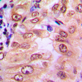 Antibody - Immunohistochemical analysis of SMAD1/9 (pS465/467) staining in human breast cancer formalin fixed paraffin embedded tissue section. The section was pre-treated using heat mediated antigen retrieval with sodium citrate buffer (pH 6.0). The section was then incubated with the antibody at room temperature and detected using an HRP-conjugated compact polymer system. DAB was used as the chromogen. The section was then counterstained with hematoxylin and mounted with DPX.