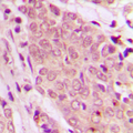 SMAD2+3 Antibody - Immunohistochemical analysis of SMAD2/3 staining in human breast cancer formalin fixed paraffin embedded tissue section. The section was pre-treated using heat mediated antigen retrieval with sodium citrate buffer (pH 6.0). The section was then incubated with the antibody at room temperature and detected using an HRP conjugated compact polymer system. DAB was used as the chromogen. The section was then counterstained with hematoxylin and mounted with DPX.