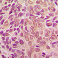SMAD2 Antibody - Immunohistochemical analysis of SMAD2 staining in human breast cancer formalin fixed paraffin embedded tissue section. The section was pre-treated using heat mediated antigen retrieval with sodium citrate buffer (pH 6.0). The section was then incubated with the antibody at room temperature and detected using an HRP conjugated compact polymer system. DAB was used as the chromogen. The section was then counterstained with hematoxylin and mounted with DPX.