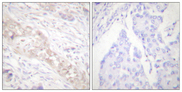 SMAD2 Antibody - Immunohistochemistry analysis of paraffin-embedded human breast carcinoma, using Smad2 (Phospho-Ser467) Antibody. The picture on the right is blocked with the phospho peptide.