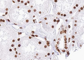 SMAD2 Antibody - 1:100 staining human kidney carcinoma tissue by IHC-P. The tissue was formaldehyde fixed and a heat mediated antigen retrieval step in citrate buffer was performed. The tissue was then blocked and incubated with the antibody for 1.5 hours at 22°C. An HRP conjugated goat anti-rabbit antibody was used as the secondary.