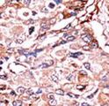 SMAD3 Antibody - Formalin-fixed and paraffin-embedded human cancer tissue reacted with the primary antibody, which was peroxidase-conjugated to the secondary antibody, followed by AEC staining. This data demonstrates the use of this antibody for immunohistochemistry; clinical relevance has not been evaluated. BC = breast carcinoma; HC = hepatocarcinoma.