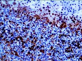 SMAD4 Antibody - IHC of SMAD4 / DPC4 on an FFPE Pancreatic Cancer Tissue