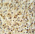 SMAGP Antibody - SMAGP Antibody immunohistochemistry of formalin-fixed and paraffin-embedded human breast carcinoma followed by peroxidase-conjugated secondary antibody and DAB staining.