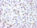 SMARCA4 / BRG1 Antibody - Detection of Mouse BRG1 by Immunohistochemistry. Sample: FFPE section of mouse renal cell carcinoma. Antibody: Affinity purified rabbit anti-BRG1 used at a dilution of 1:1000 (1 ug/ml). Detection: DAB.