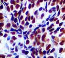SMARCB1 / INI1 Antibody - IHC of INI-1 on FFPE Ewing's Sarcoma tissue.
