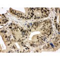 SMC3 / HCAP Antibody - SMC3 antibody IHC-paraffin. IHC(P): Human Intestinal Cancer Tissue.