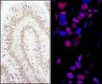 SMEK1 Antibody - Detection of Human PPP4R3 Alpha by Immunohistochemistry and Immunofluorescence. Sample: FFPE sections of human colon carcinoma (left) and breast carcinoma (right). Antibody: Affinity purified rabbit anti-PPP4R3 Alpha used at a dilution of 1:200 (1 ug/ml) and 1:80 (2.5 ug/ml). Detection: DAB and Red-fluorescent Goat anti-Rabbit IgG-heavy and light chain, cross-adsorbed Antibody DyLight 594 Conjugated used at a dilution of 1:100.
