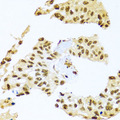 SMEK1 Antibody - Immunohistochemistry of paraffin-embedded human lung cancer tissue.