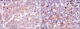 SMN1 Antibody - IHC of paraffin-embedded stomach cancer tissues (left) and brain tumor (right) using SMN1 mouse monoclonal antibody with DAB staining.