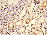 SMOC1 Antibody - Immunohistochemistry of paraffin-embedded human gastric cancer at dilution 1:100